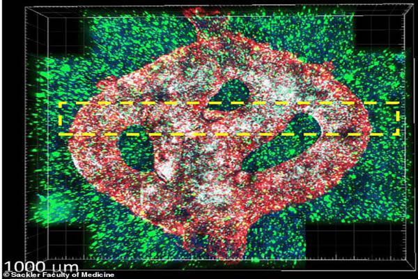 نخستین تصویر 3 بُعدی از یک تومور مغزی کشنده